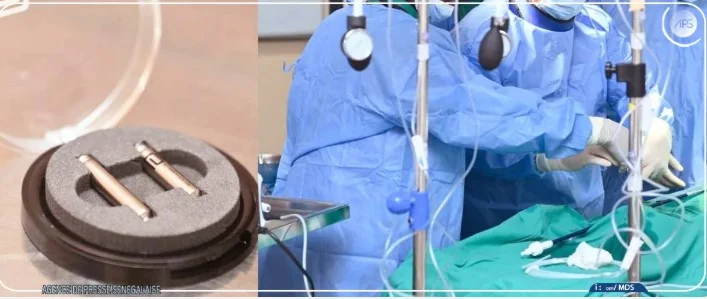 Sénégal : premier pacemaker sans sonde en Afrique de l'Ouest, un bond technologique